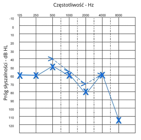 audiogram krzywa powietrzna i kostna odbiorczy