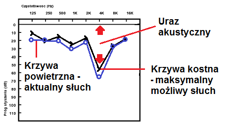 uraz akustyczny