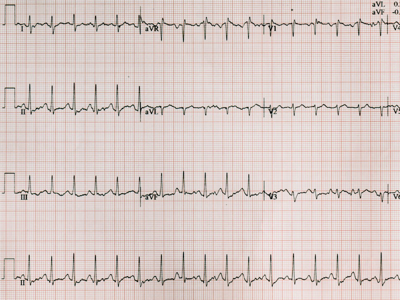 zapis badania ekg